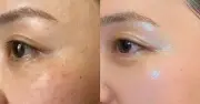 Top 5 serum mờ nám hỗn hợp, kể cả nám lâu năm cũng cải thiện nhanh chóng