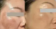 Top 5 serum mờ nám mảng giúp da trắng hồng sau 4 tuần