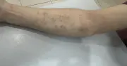 Trị tận gốc viêm da mùa nắng nóng bằng y học toàn diện