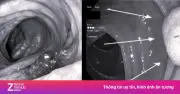 Ung thư đại trực tràng gia tăng ở người trẻ: 4 dấu hiệu cảnh báo sớm không thể bỏ qua