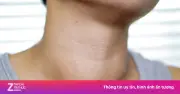 Ung thư tuyến giáp: 5 nhóm nguy cơ cao cần tầm soát, tỷ lệ sống trên 95% nếu phát hiện sớm