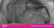 Vi nhựa và thực phẩm siêu chế biến: 'Sát thủ vô hình' gây ung thư đại trực tràng ở người trẻ