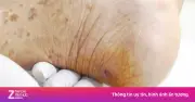 Vết thương nhỏ tưởng lành, hai bệnh nhân nguy kịch vì uốn ván