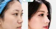 Xóa mũi tẹt cho thanh thiếu niên Việt: Cơ hội nâng mũi miễn phí gần 100 triệu đồng