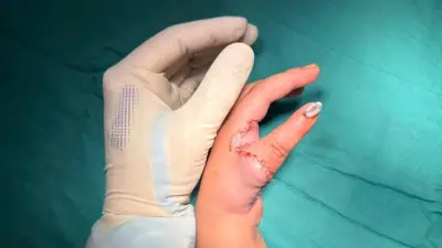 Bệnh nhi thiểu sản ngón cái được tái tạo bằng chính ngón trỏ