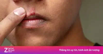 Ung thư lưỡi: Ca phẫu thuật tái tạo giúp bệnh nhân giữ được tiếng nói