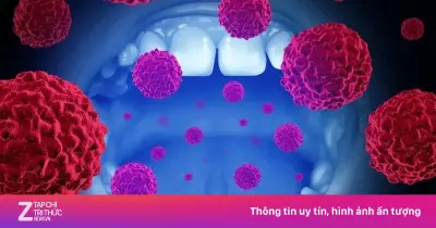 Ung thư miệng giai đoạn IV, phát hiện thêm u đại trực tràng