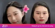 Cô gái bị bạch biến tìm lại màu da sau 6 năm ghép tế bào sắc tố