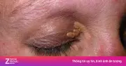 Dấu hiệu bệnh gan biểu hiện ở mắt: Không chỉ vàng mắt