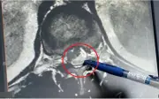 Ám ảnh 12 năm: Ấu trùng sán dây trong tủy sống người đàn ông 55 tuổi