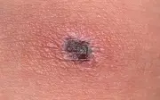 Người phụ nữ suýt chết vì sốt phát ban do ve, vết loét bị tóc che khuất