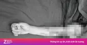 Nối thành công cánh tay đứt rời cho bé 4 tuổi do áo chống nắng