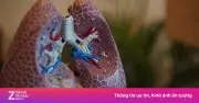 Nấm phổi mạn tính: Tỷ lệ tử vong 80%, khó chẩn đoán