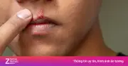 Ung thư lưỡi: Ca phẫu thuật tái tạo giúp bệnh nhân giữ được tiếng nói